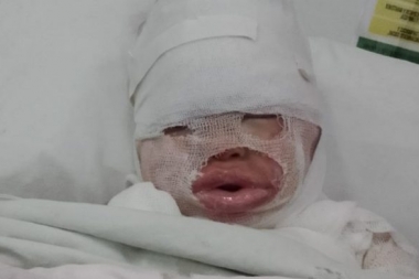 Una empleada de un restaurante quemó que aceite hirviendo a una nena de 3 años